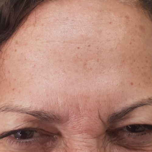 AC Paiva Odontologia Harmonização Facial Depois Goiânia Goiás